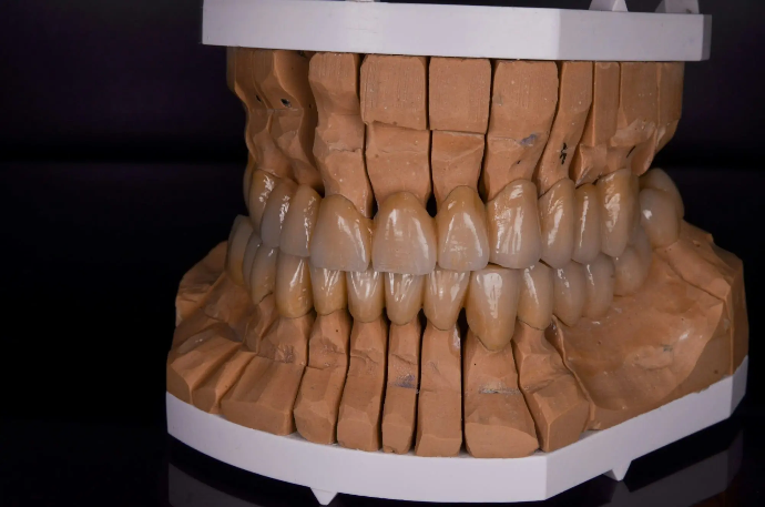 All-ceramic dental restorations