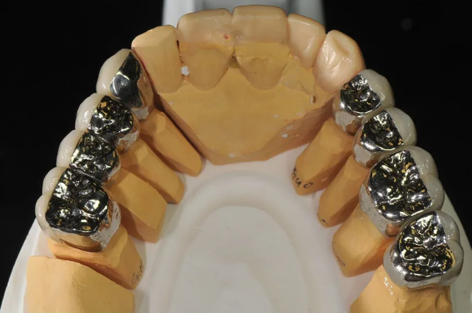 Full metal and gold crown restorations
